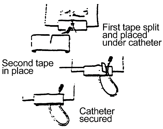 Procedure Principles for Dressing Change of CVL procedure illustration