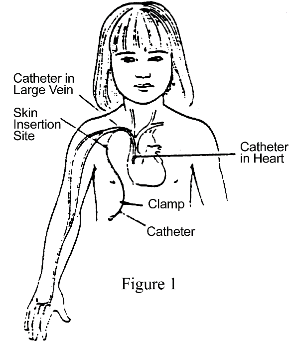 Central Venous Line (CVL) procedure illustration