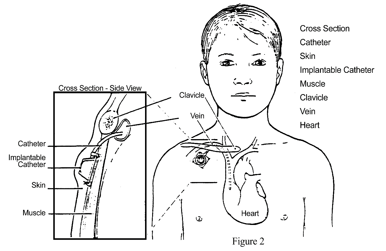 Central Venous Line (CVL) procedure illustration