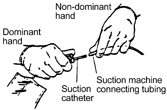 Procedure for Tracheostomy Suctioning procedure illustration