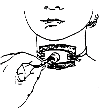 Procedure for Tracheostomy Suctioning procedure illustration