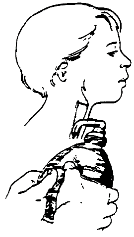 Procedure for Tracheostomy Suctioning procedure illustration