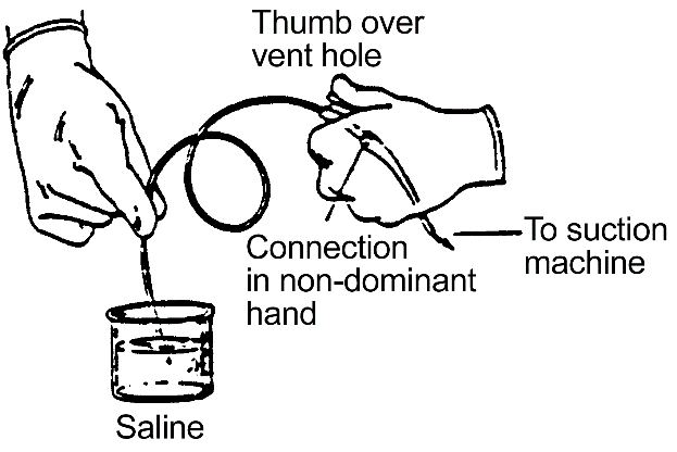 Procedure for Tracheostomy Suctioning procedure illustration