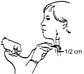 Procedure for Tracheostomy Suctioning procedure illustration