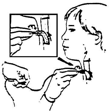 Procedure for Tracheostomy Suctioning procedure illustration