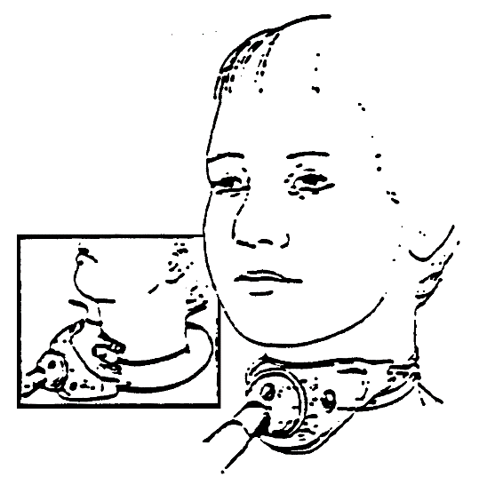 Procedure for Tracheostomy Collar procedure illustration