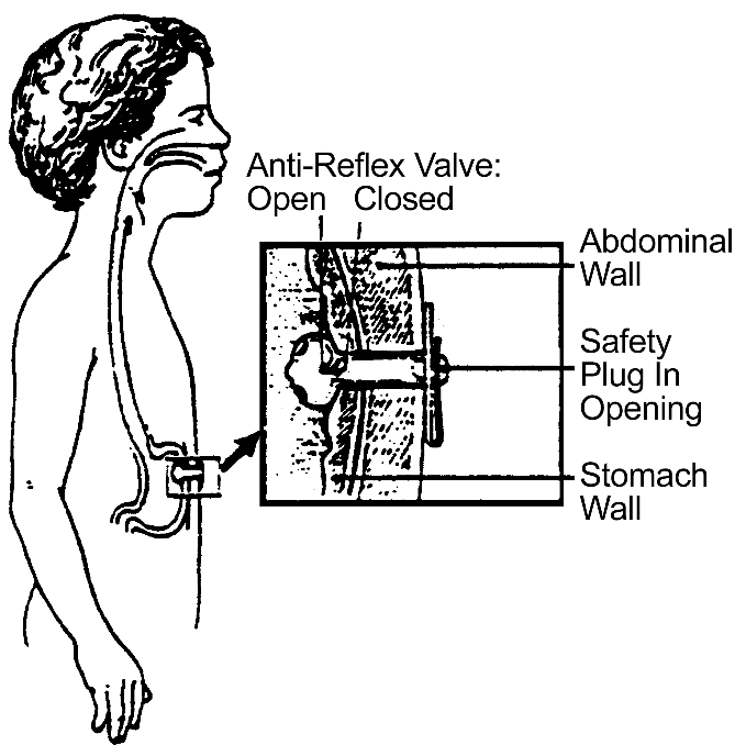 Tube Feeding (Gastrostomy) procedure illustration