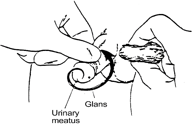 Procedure for Clean Intermittent Catheterization – Male: procedure illustration