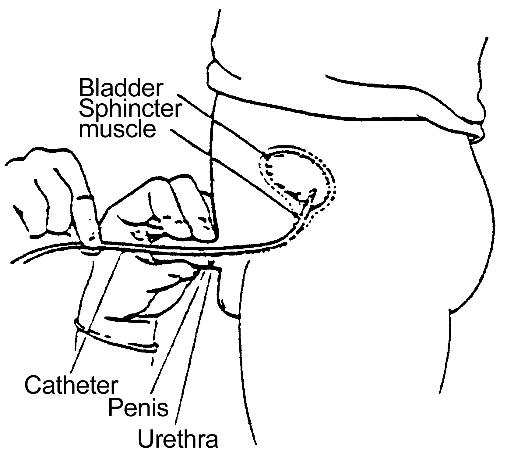 Procedure for Clean Intermittent Catheterization – Male: procedure illustration