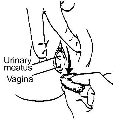 Procedure for Clean Intermittent Catheterization – Female: procedure illustration