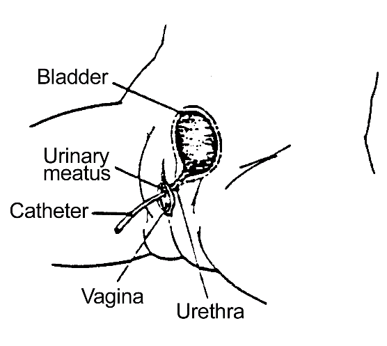 Procedure for Clean Intermittent Catheterization – Female: procedure illustration